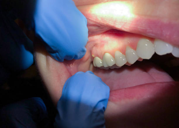 Best Broken or Chipped Tooth Repair in Colquitt, GA